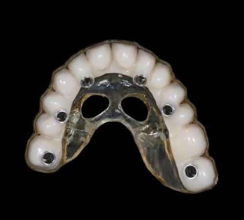 Ghid chirurgical All on x cu foraje pentru implanturi — laborator București