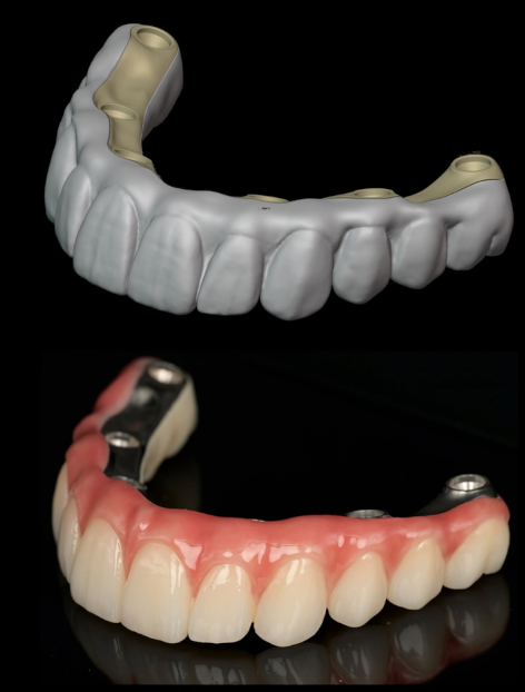 Punte totală pe implant, structură și lucrare finalizată — All on 4/6, laborator Râmnicu Vâlcea