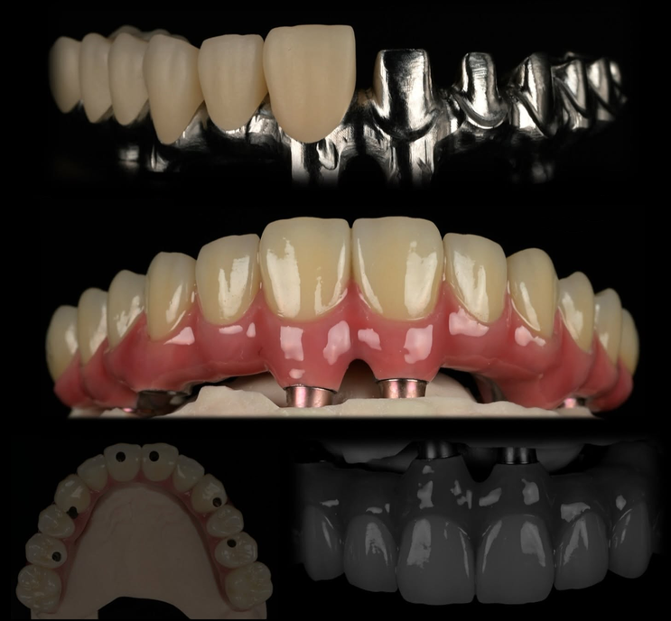 Etape lucrare All on 4/6 pe structură metalică — laborator Râmnicu Vâlcea