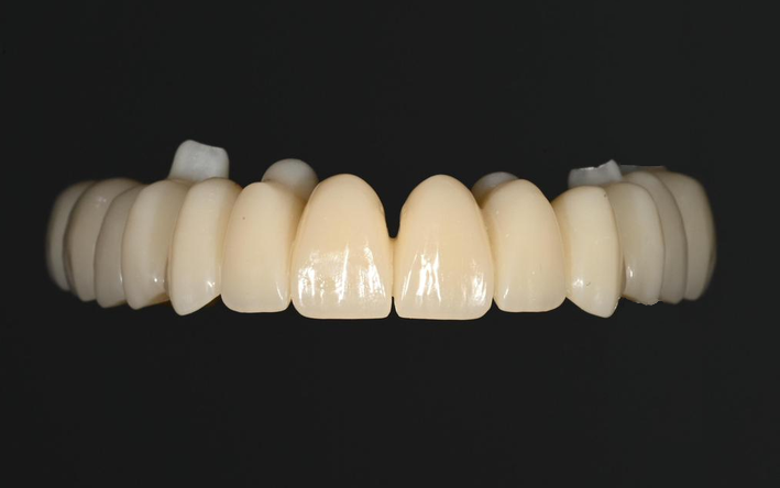 Lucrare Easy Anatomic din PMMA / compozit — laborator tehnică dentară Râmnicu Vâlcea