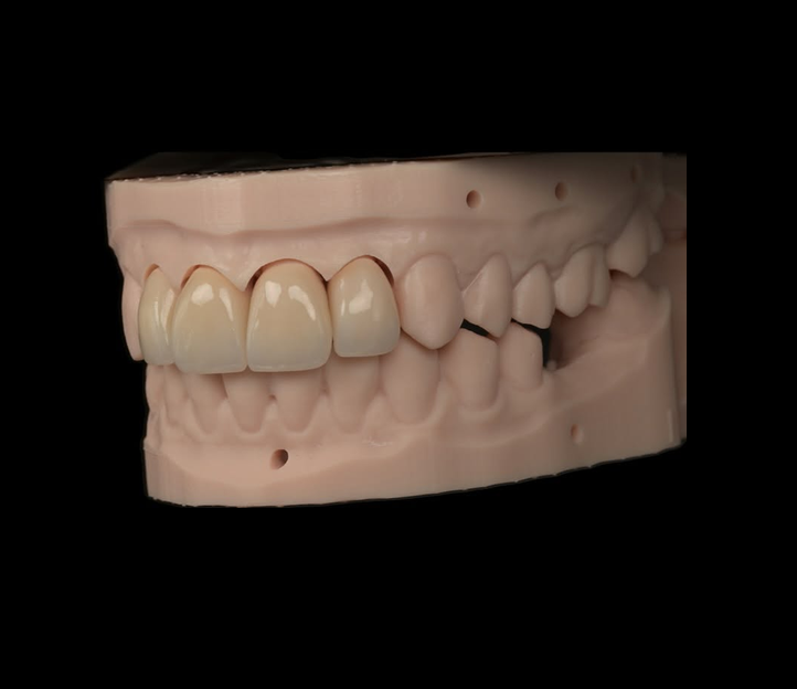Lucrare total fizionomică din zirconiu pe model — Full Anatomic, laborator Râmnicu Vâlcea