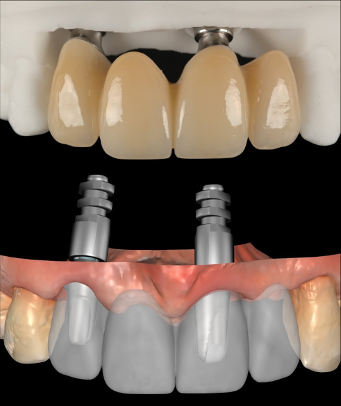 Punte fizionomică pe implant, planificare digitală — Full Anatomic, laborator Râmnicu Vâlcea