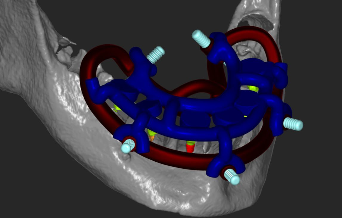 Planificare digitală implanturi pe ghid chirurgical All on x — laborator Râmnicu Vâlcea