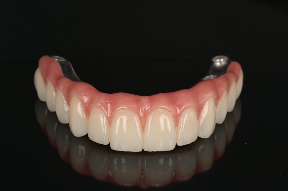 Lucrare All on 4/6 pe implant din zirconiu — laborator tehnică dentară Timișoara
