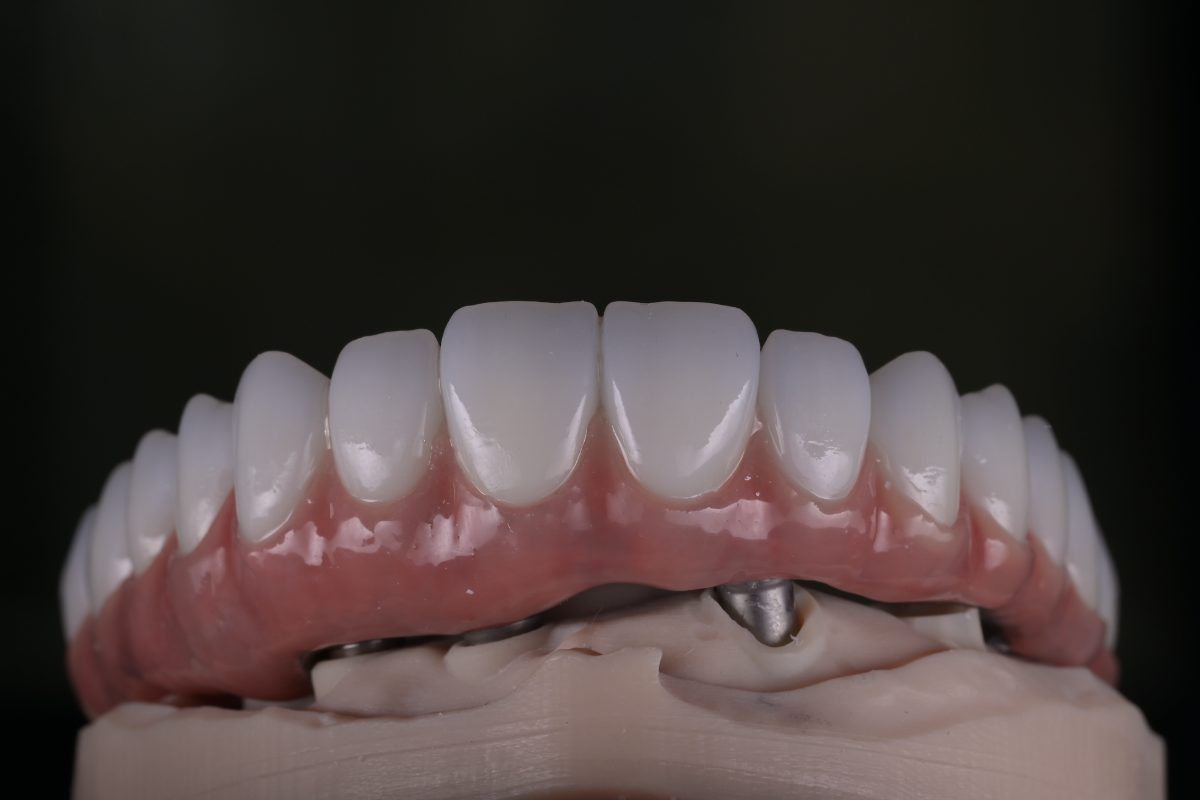 Punte totală pe implant, ceramizare gingivală — laborator Timișoara