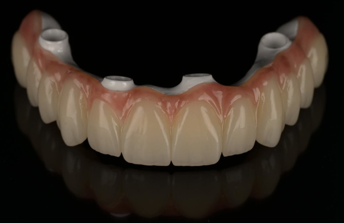 Lucrare All on 4/6 înșurubată pe implant, zirconiu — laborator Timișoara