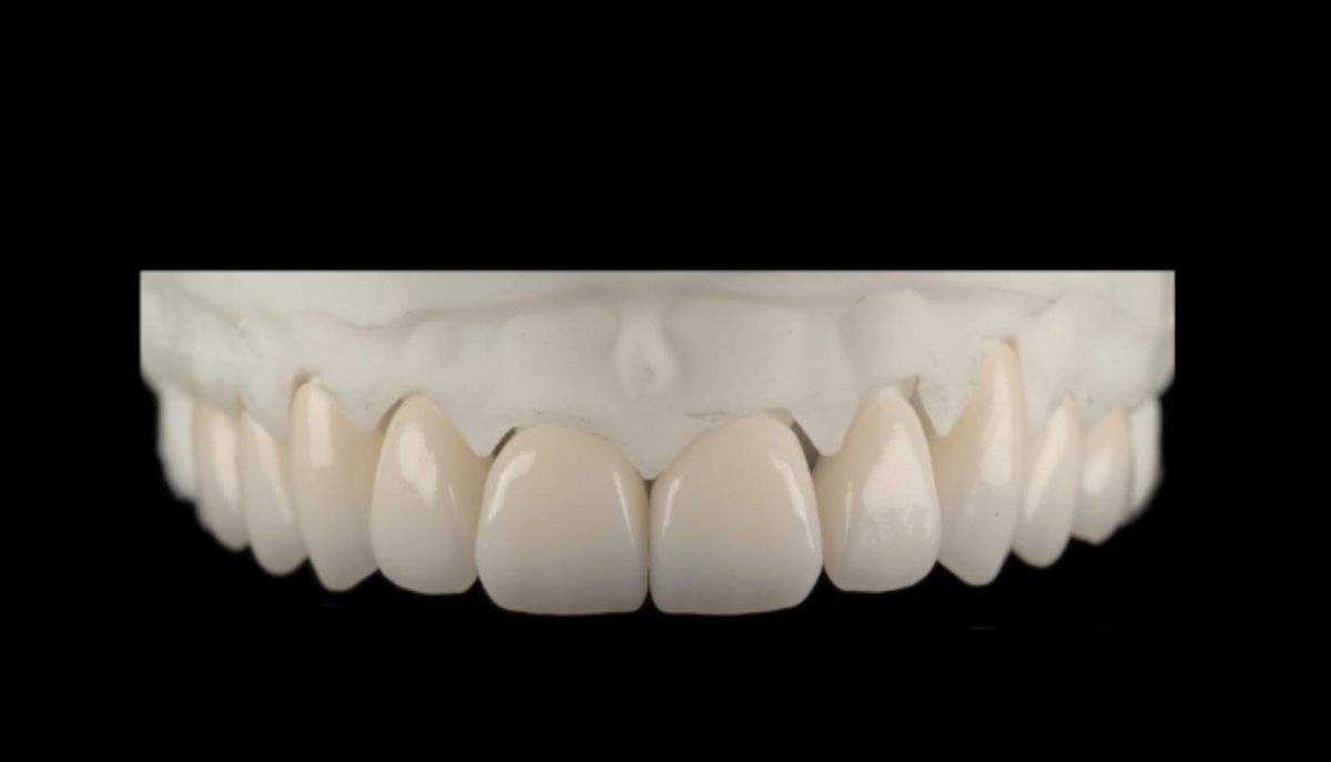 Coroane frontale total fizionomice din zirconiu — Full Anatomic, laborator Timișoara