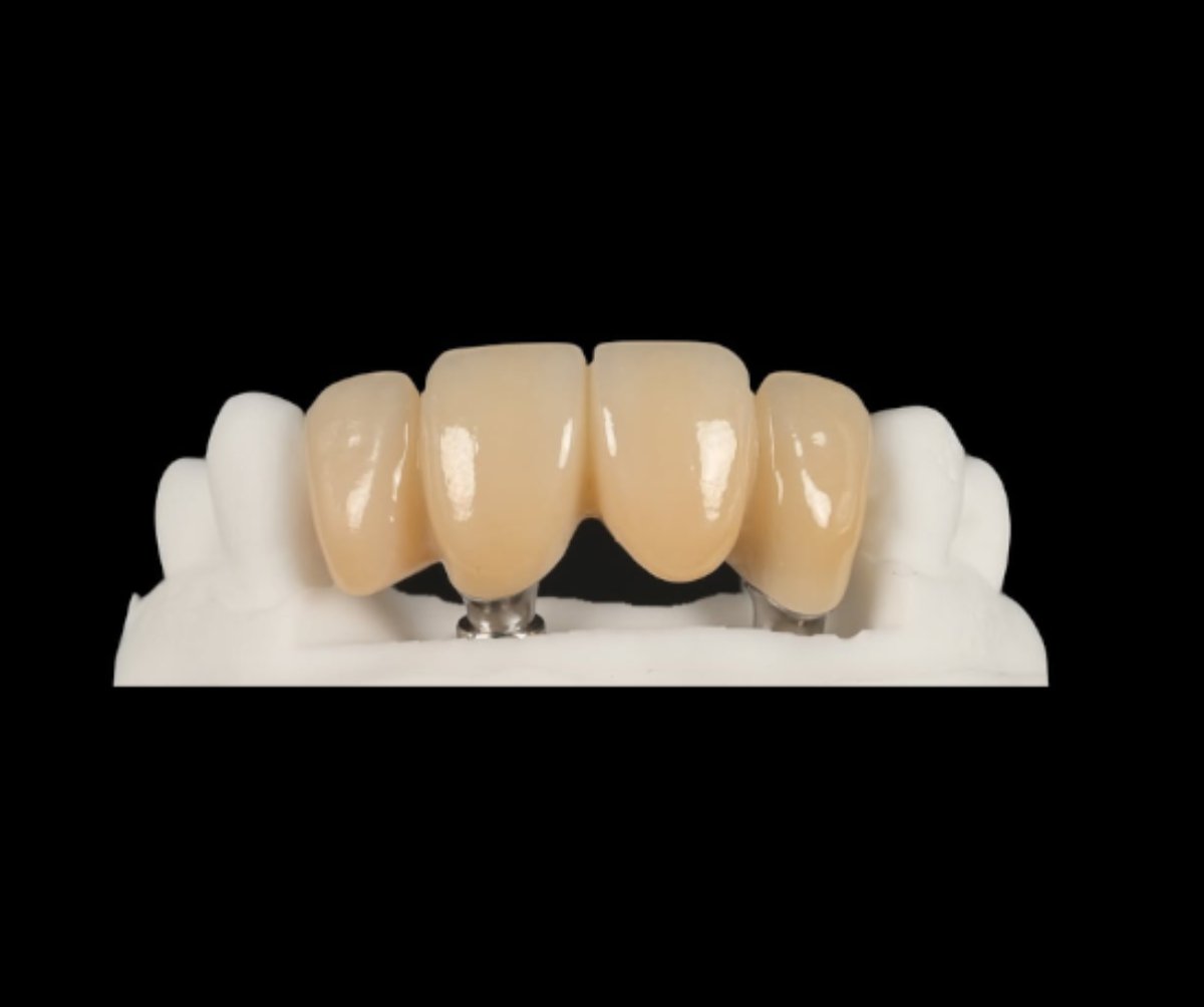 Punte fizionomică pe implant din zirconiu — Full Anatomic, laborator Timișoara