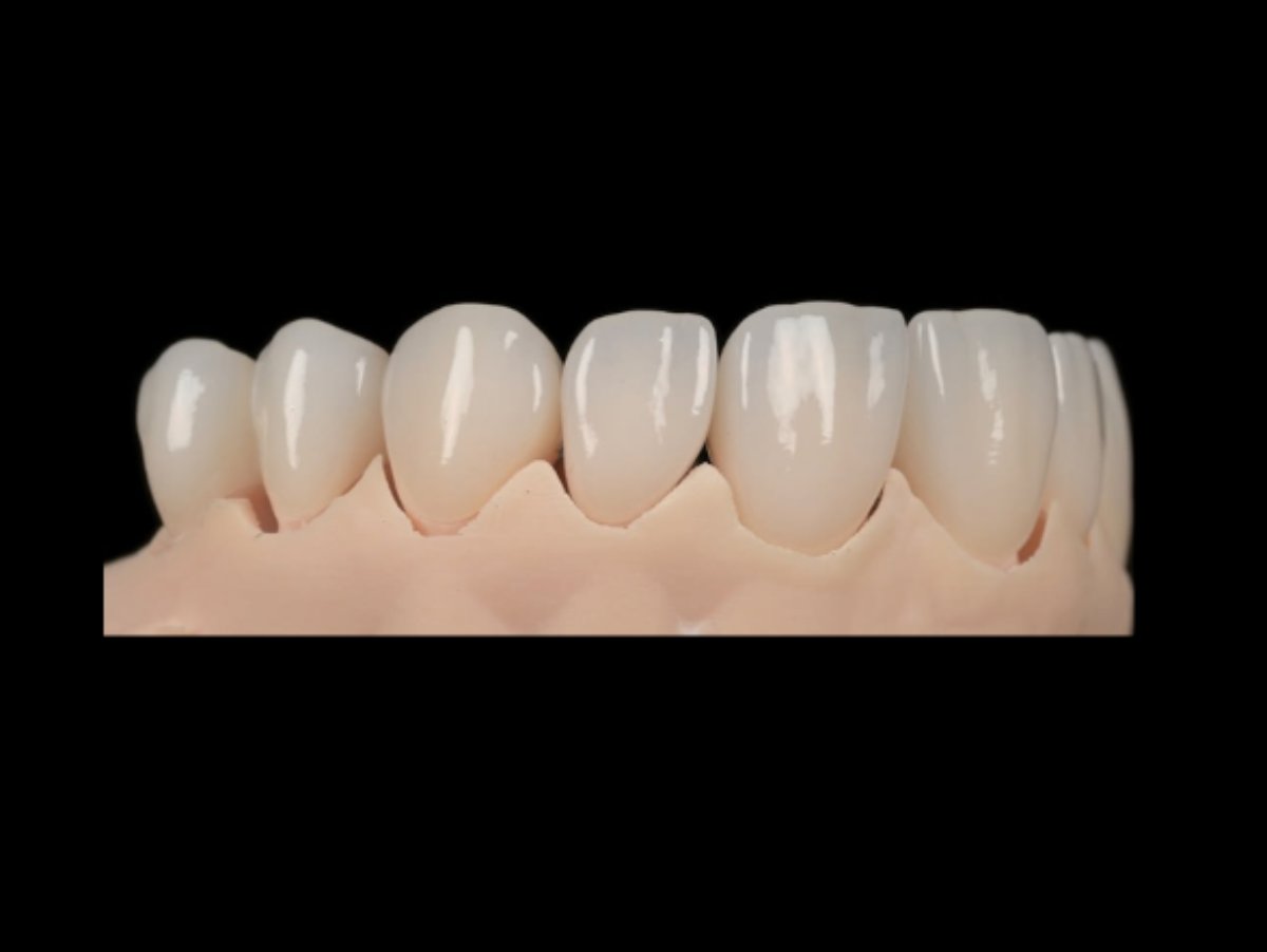 Coroane fizionomice pe model din zirconiu — Full Anatomic, laborator Timișoara