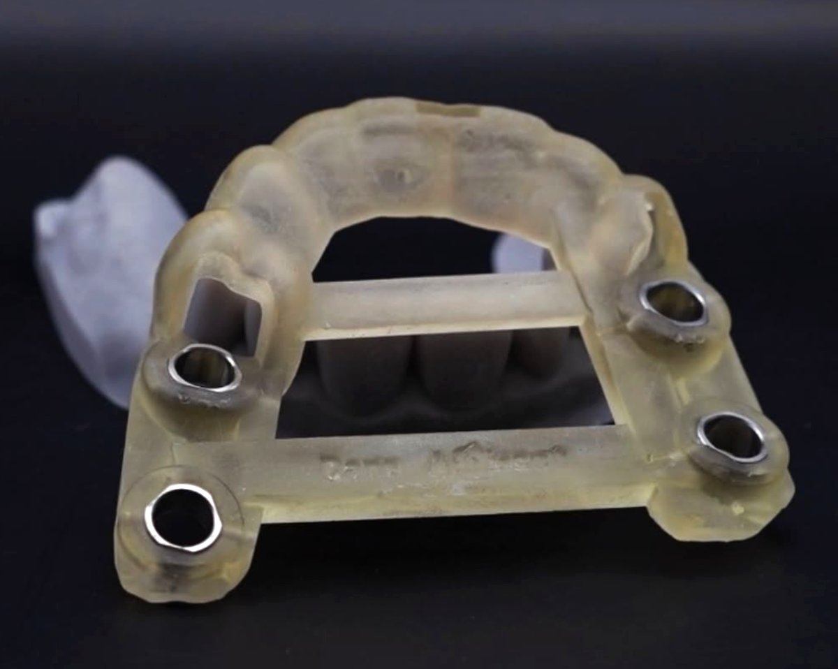 Ghid chirurgical 3DentaGuide printat 3D pentru implanturi — laborator Timișoara